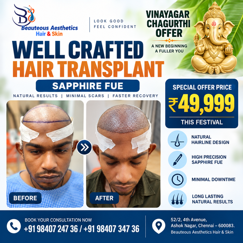 Well Crafted Hair Transplant in Chennai with Sapphire FUE – Vinayagar Chaturthi Special Offer