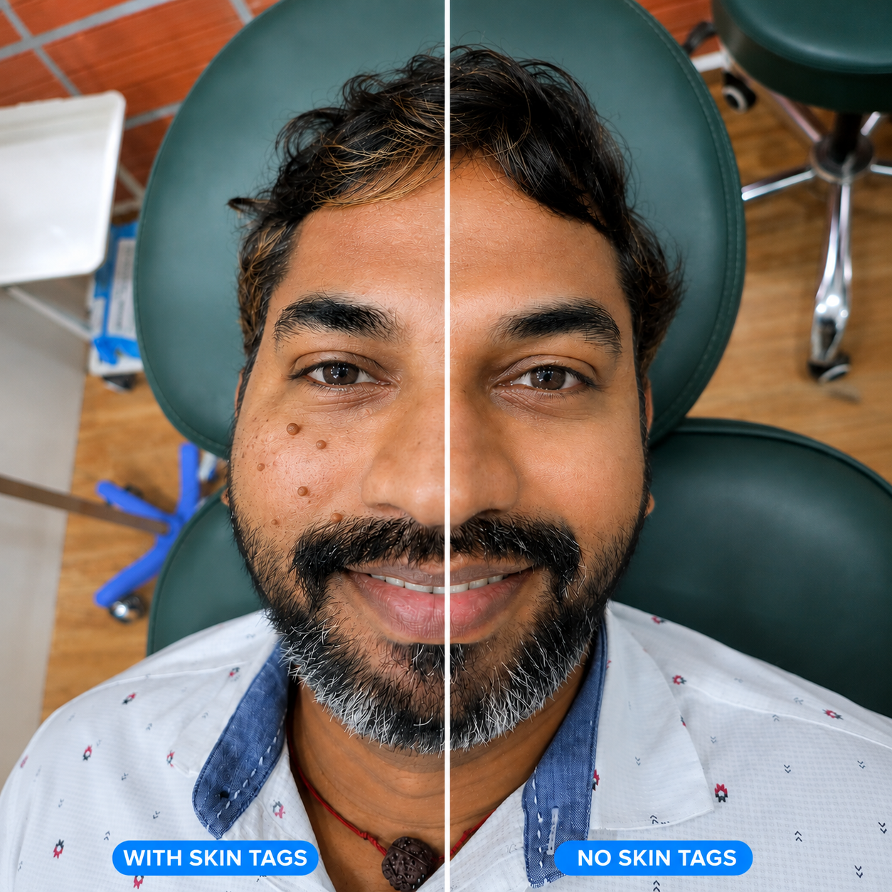 Skin Tag Removal in Chennai Beautious Aesthetics